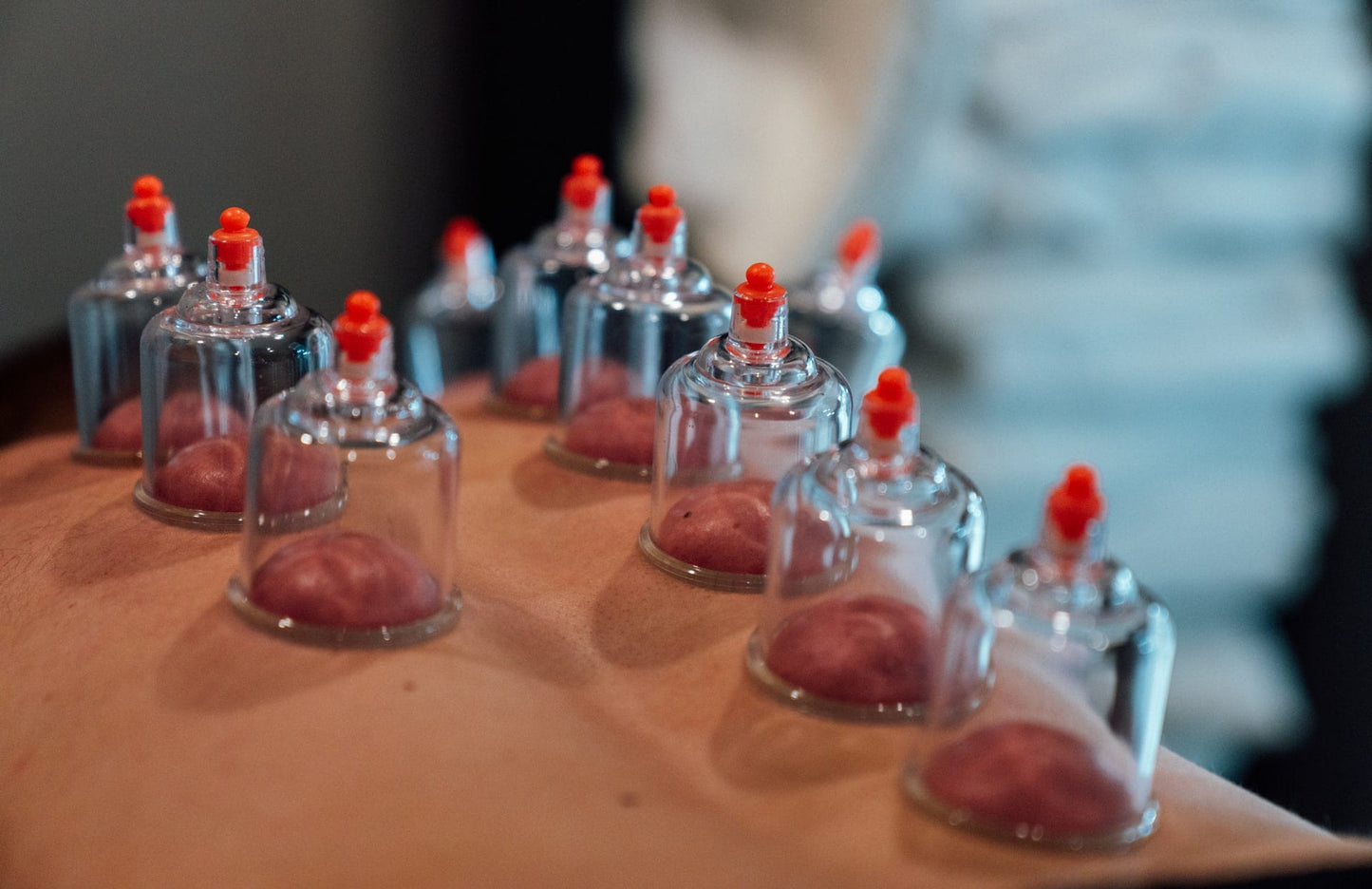 back cupping
