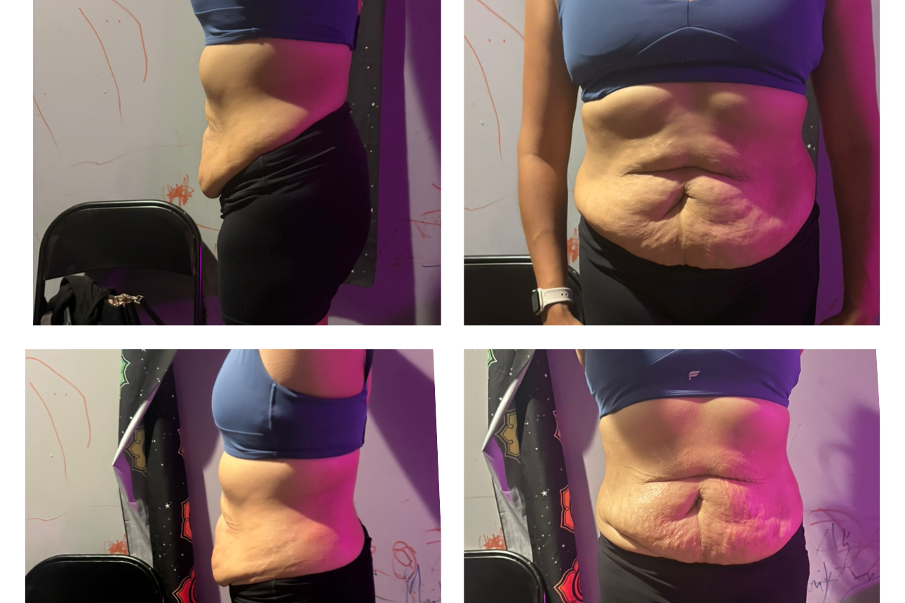 Laser Lipo