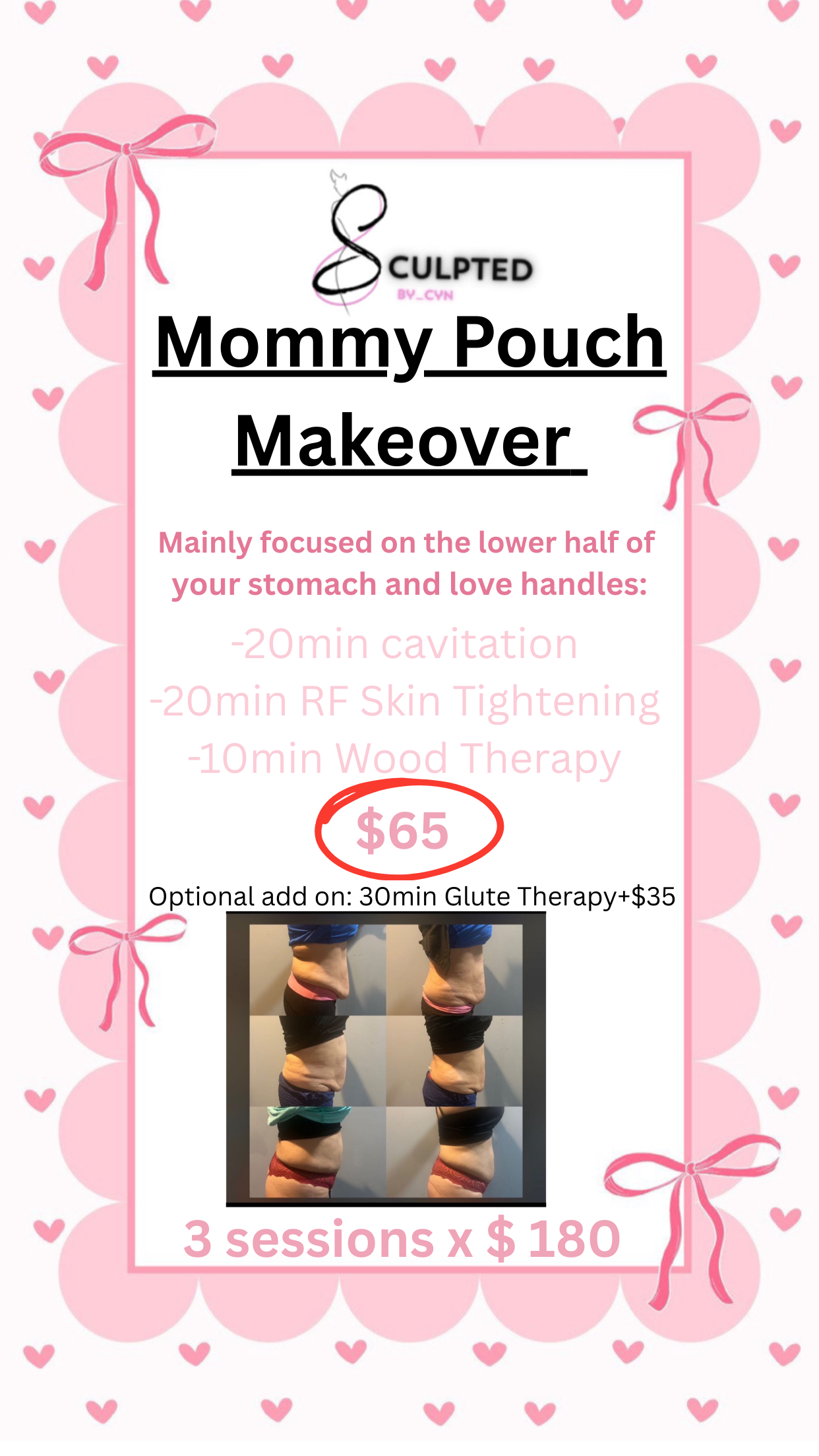 mommy pouch makeover