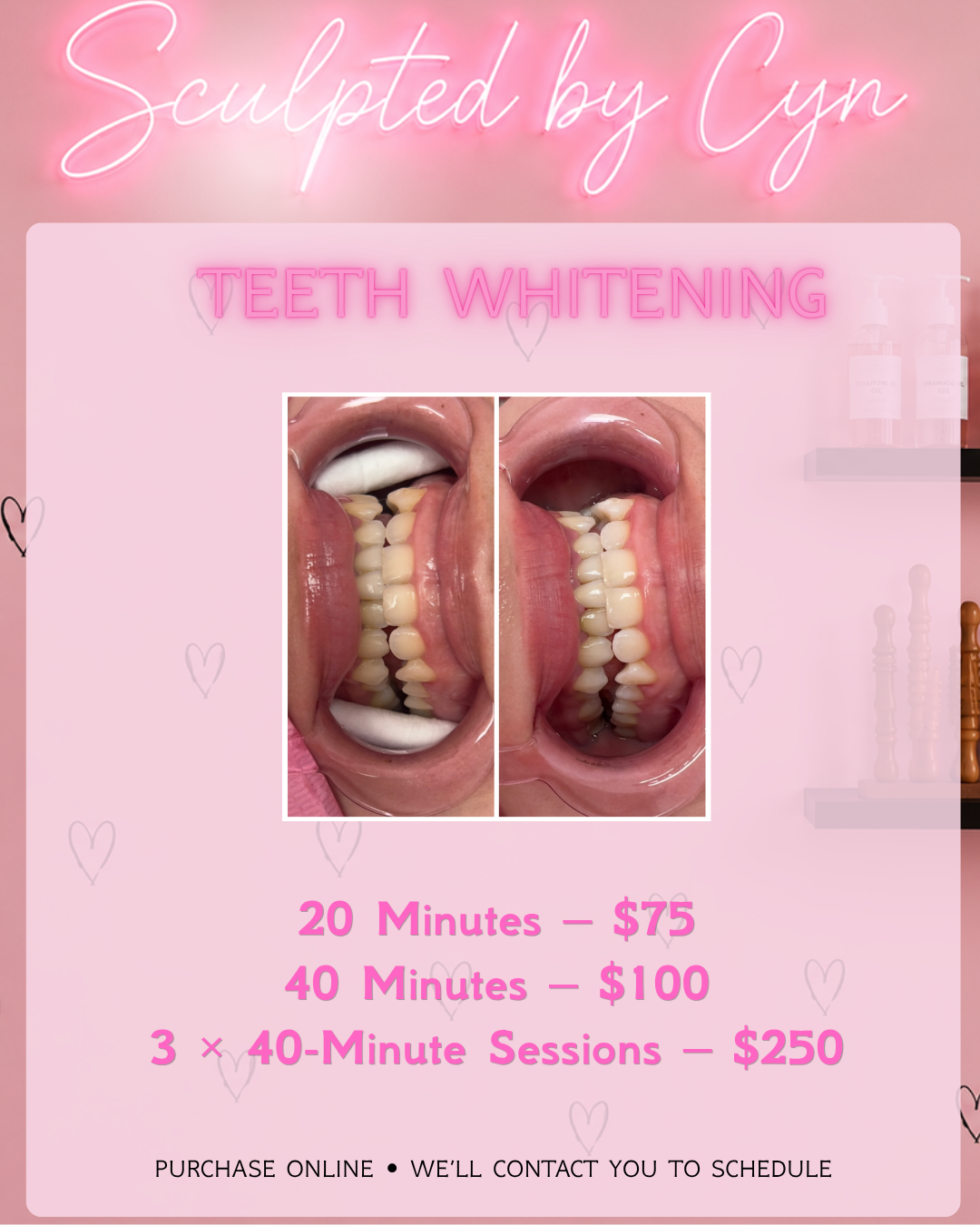 Teeth Whitening