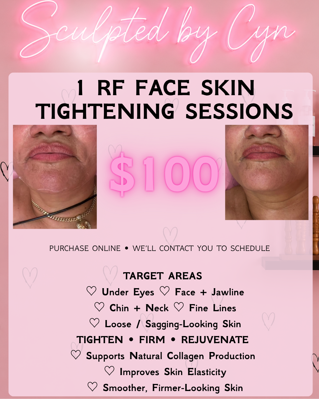 RF Face tightening