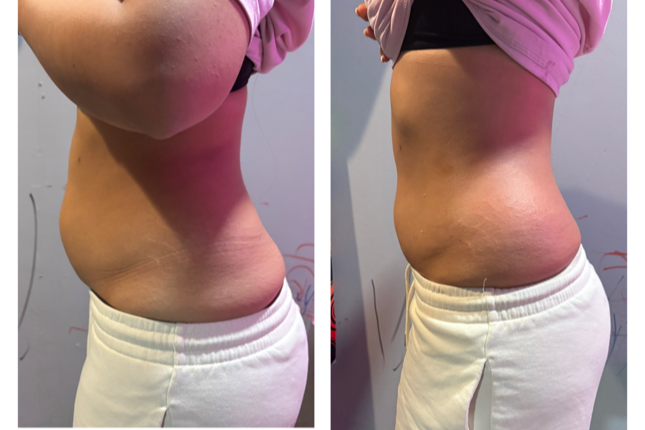 Before and after comparison of a person's waist area wearing white shorts.