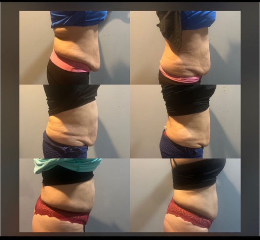 3 body sculpting + 1 fat dissolver