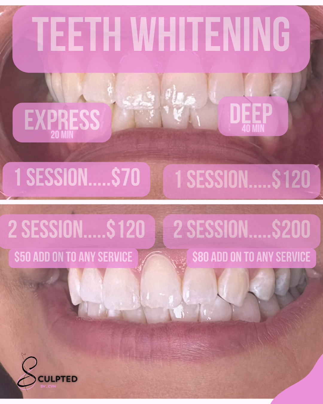 teeth whitening