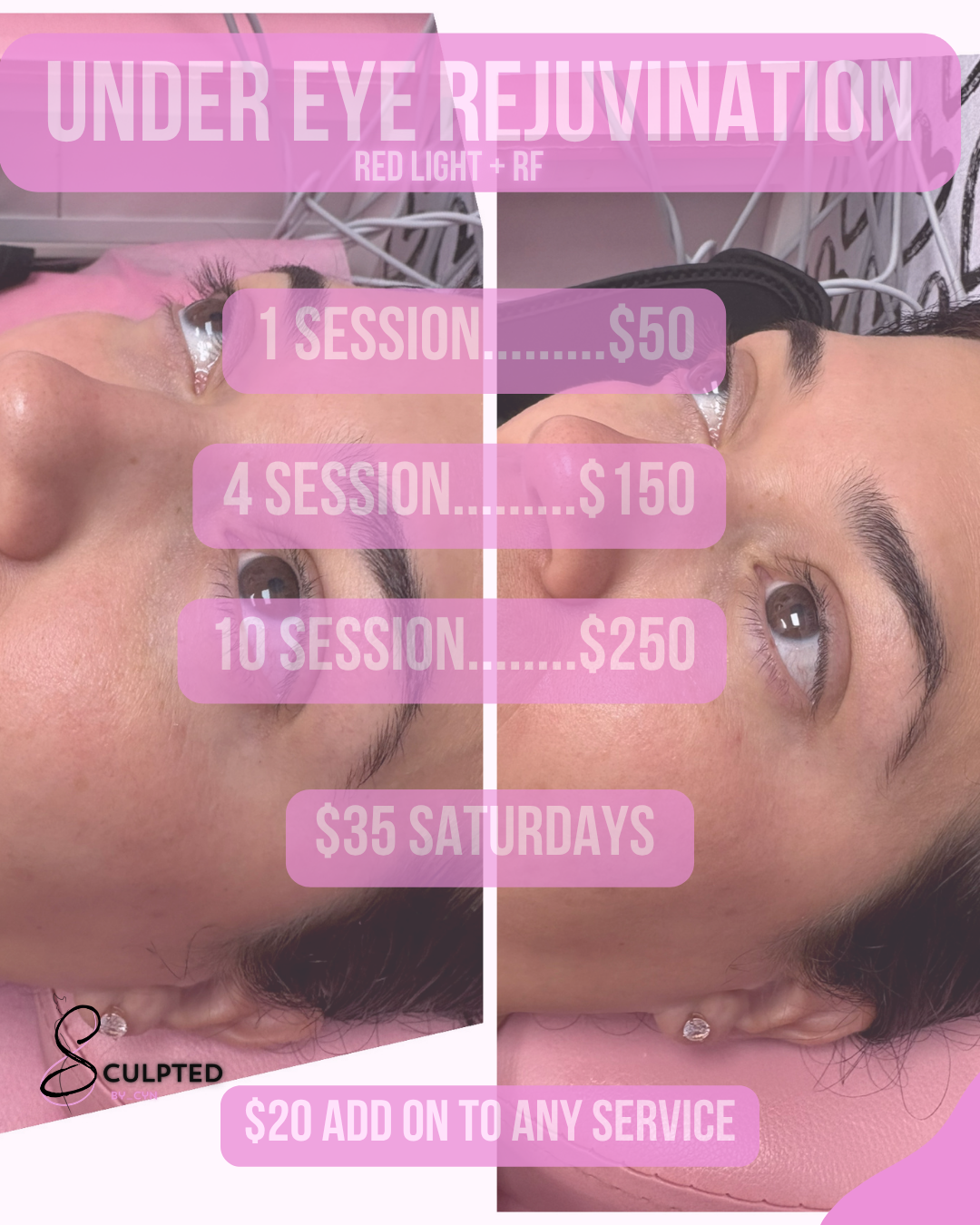 RF Neck Tightening / under eye rejuvination