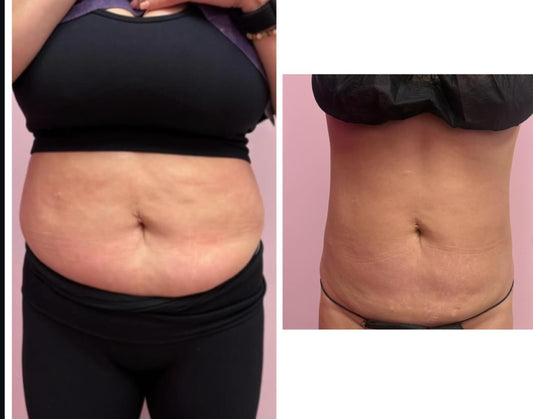 3 DISSOLVERS + 4 BODY SCULPTING SESSIONS